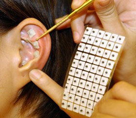 L’art de soigner par l’acupuncture de l’oreille