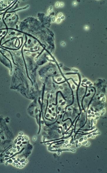 Dépression mentale et candida albicans en médecine chinoise