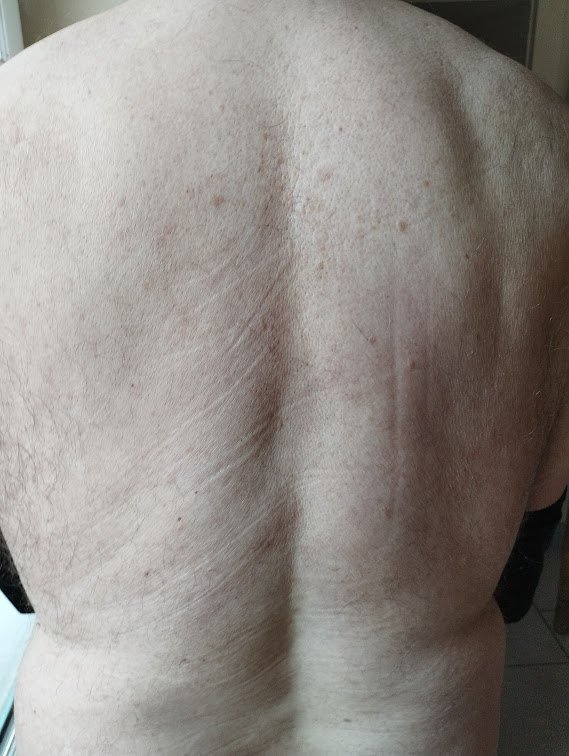 Le dos du patient après 3 semaines de traitement, sans eczéma