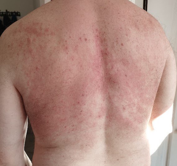 Le dos du patient avant le traitement, couvert d'eczéma rouge