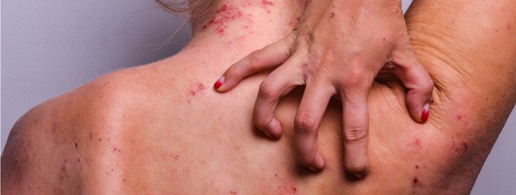 Résultat fulgurant sur un eczéma grâce aux prescriptions classiques (jīng fāng 经方)