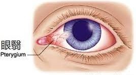Syndromes oculaires selon la théorie des 5 roues